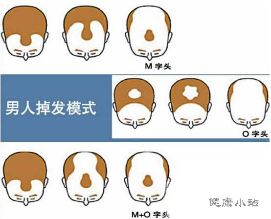 为什么会掉头发